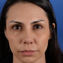 Revision Rhinoplasty Before & After Patient #3019