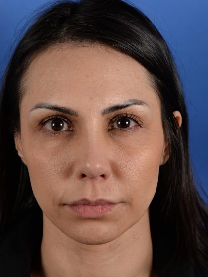 Revision Rhinoplasty Before & After Patient #3019