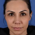 Revision Rhinoplasty Before & After Patient #3019