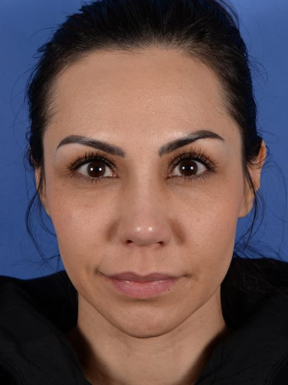Revision Rhinoplasty Before & After Patient #3019