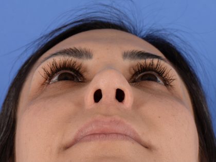 Revision Rhinoplasty Before & After Patient #3019