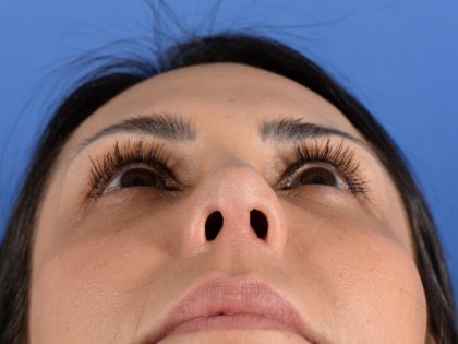 Revision Rhinoplasty Before & After Patient #3019