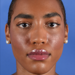 Facial Reshaping Before & After Patient #3012
