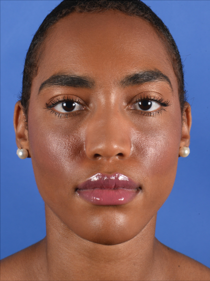 Facial Reshaping Before & After Patient #3012
