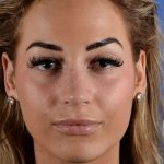 Primary Rhinoplasty Before & After Patient #2963