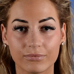 Primary Rhinoplasty Before & After Patient #2963