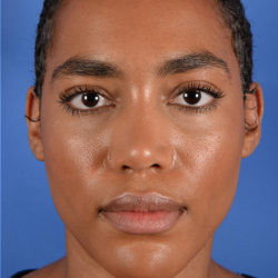Facial Reshaping Before & After Patient #3012