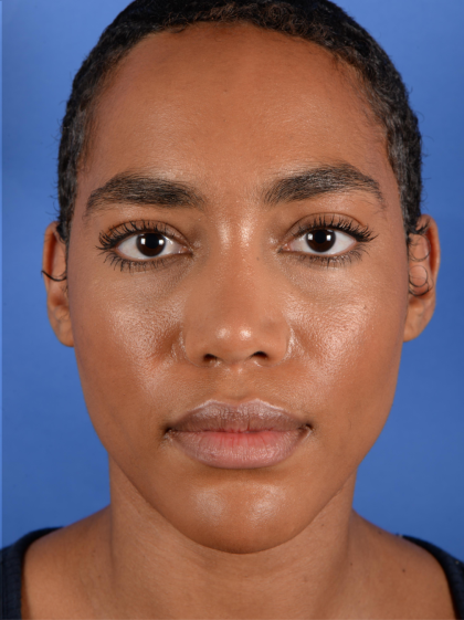 Facial Reshaping Before & After Patient #3012