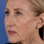 Face Lift - Neck Lift Before & After Patient #3002