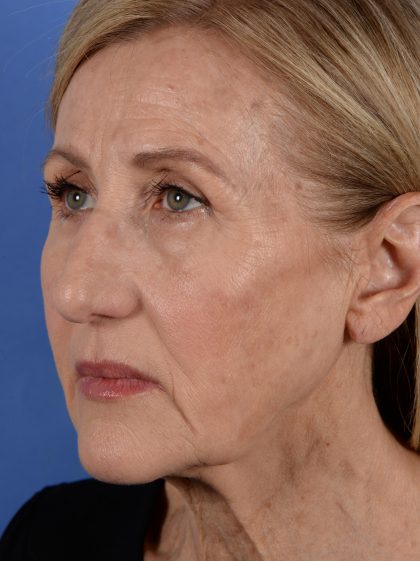 Face Lift - Neck Lift Before & After Patient #3002