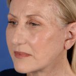 Face Lift - Neck Lift Before & After Patient #3002