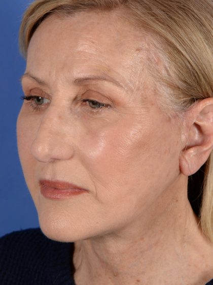 Face Lift - Neck Lift Before & After Patient #3002