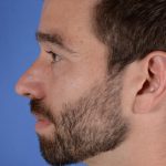 Facial Reshaping Before & After Patient #3003