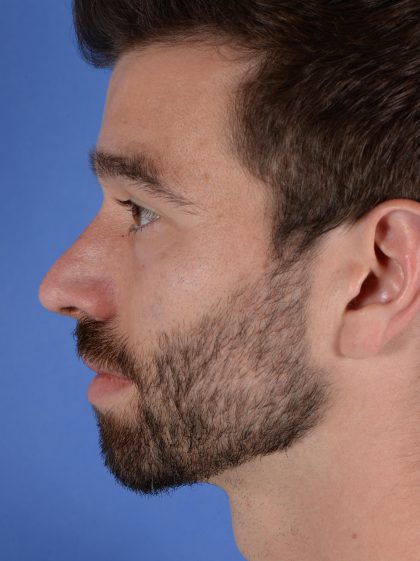 Facial Reshaping Before & After Patient #3003