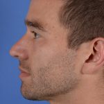 Facial Reshaping Before & After Patient #3003