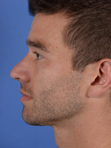 Facial Reshaping Before & After Patient #3003