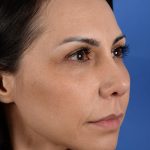Revision Rhinoplasty Before & After Patient #3019