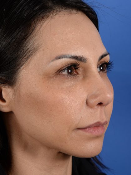 Revision Rhinoplasty Before & After Patient #3019