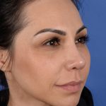 Revision Rhinoplasty Before & After Patient #3019