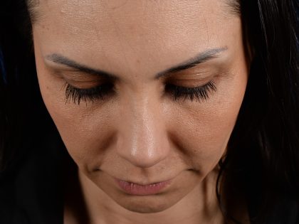 Revision Rhinoplasty Before & After Patient #3019