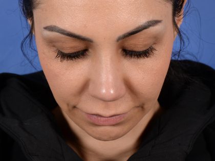 Revision Rhinoplasty Before & After Patient #3019