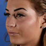 Primary Rhinoplasty Before & After Patient #2963