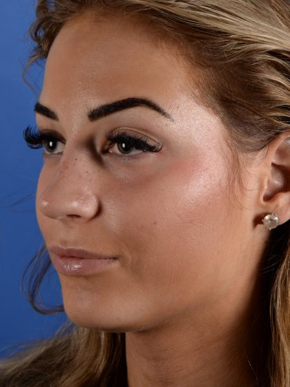 Primary Rhinoplasty Before & After Patient #2963