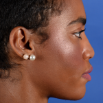 Facial Reshaping Before & After Patient #3012