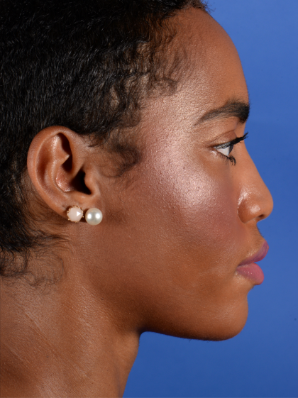 Facial Reshaping Before & After Patient #3012
