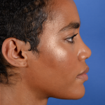 Facial Reshaping Before & After Patient #3012