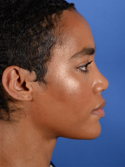 Facial Reshaping Before & After Patient #3012
