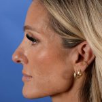 Primary Rhinoplasty Before & After Patient #2966