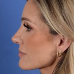 Primary Rhinoplasty Before & After Patient #2966
