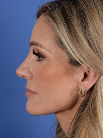 Primary Rhinoplasty Before & After Patient #2966