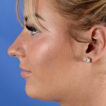 Primary Rhinoplasty Before & After Patient #2963