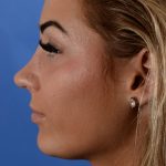 Primary Rhinoplasty Before & After Patient #2963