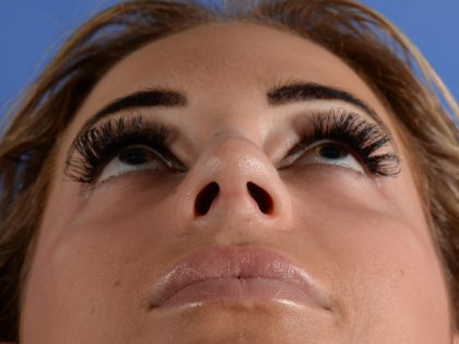 Primary Rhinoplasty Before & After Patient #2963
