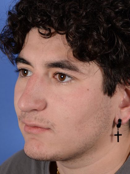Primary Rhinoplasty Before & After Patient #2967