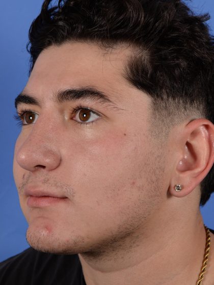 Primary Rhinoplasty Before & After Patient #2967