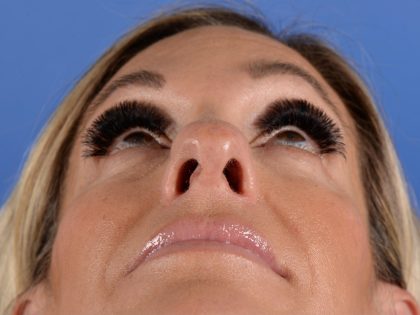 Primary Rhinoplasty Before & After Patient #2966
