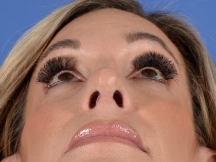 Primary Rhinoplasty Before & After Patient #2966