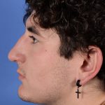 Primary Rhinoplasty Before & After Patient #2967