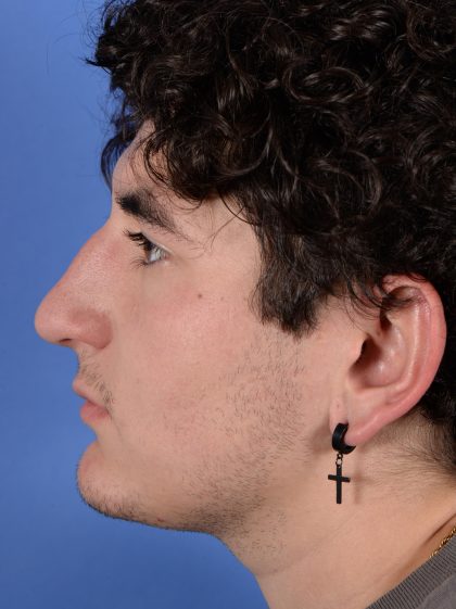 Primary Rhinoplasty Before & After Patient #2967