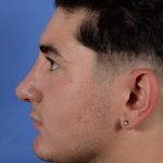 Primary Rhinoplasty Before & After Patient #2967