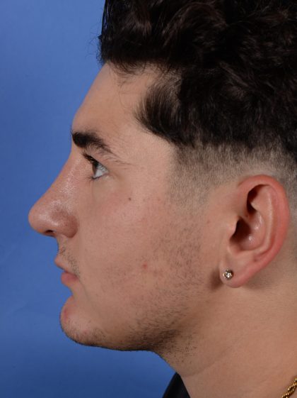 Primary Rhinoplasty Before & After Patient #2967