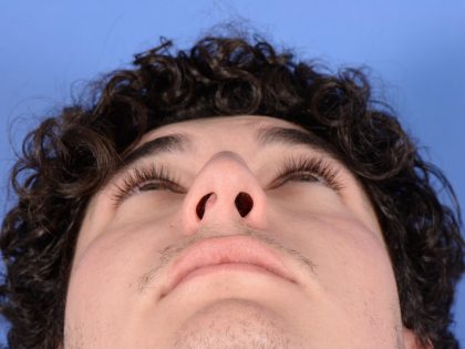 Primary Rhinoplasty Before & After Patient #2967