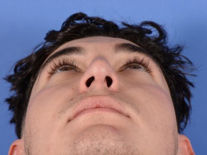 Primary Rhinoplasty Before & After Patient #2967