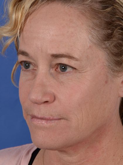 Primary Rhinoplasty Before & After Patient #3105