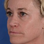 Primary Rhinoplasty Before & After Patient #3105