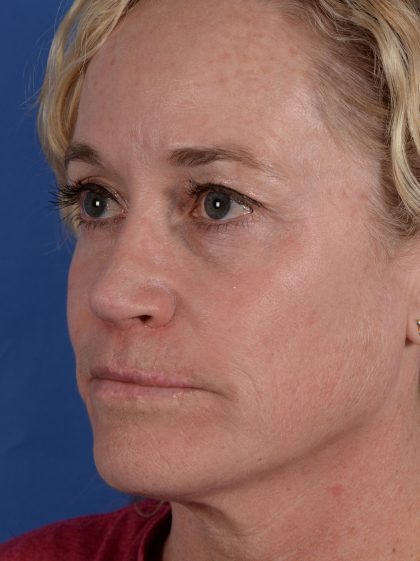 Primary Rhinoplasty Before & After Patient #3105